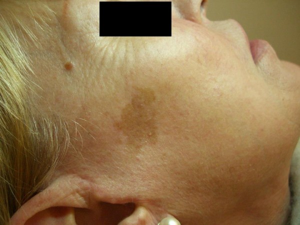 Before image