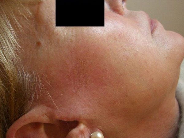 After image