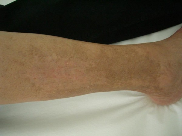 After image